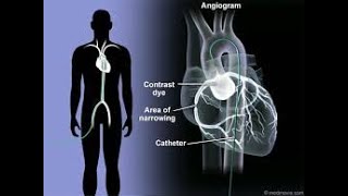 Coronary Arteriography  Coronary Angiography  Definition Procedure Uses Benefits [upl. by Cristen]