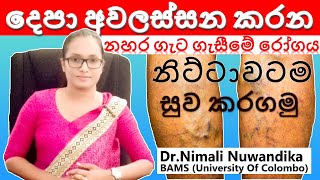 Treatments for Varicose veins  නහර ගැටගැසීම නිට්ටාවටම සුවකරගමු  Dr Nimali Nuwandika [upl. by Stromberg109]