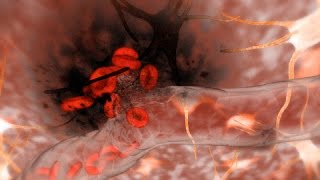 Hemorrhagic Stroke Brain Hemorrhage [upl. by Willabella]