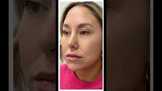 Before and After Lip Filler revivechattanooga lipfiller [upl. by Conley538]