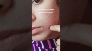 3 weeks on tretinoin 001 ℅ gel Wanna use tretinoin but didnt heard about skin peeling tretinoin [upl. by Cami]