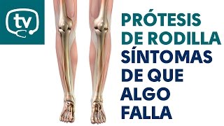 Cómo saber si mi prótesis de rodilla no funciona bien [upl. by Sirah]