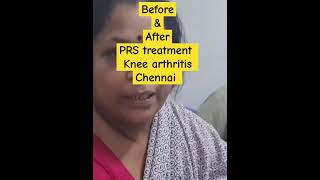 PRS treatment knee osteoarthritis Chennai India amazing recovery [upl. by Yenaffit13]