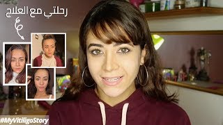 My Vitiligo Story  رحلتي مع العلاج [upl. by Barbara-Anne]