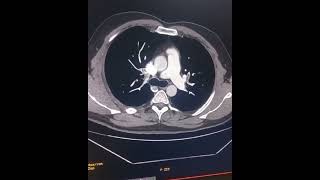 CT pulmonary embolism [upl. by Natalina]