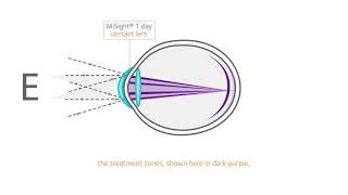 How does MiSight work [upl. by Leilah]