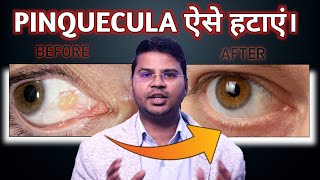 How To Remove Pinquecula सबसे आसान उपाय Lokesh Dixit [upl. by Gan631]