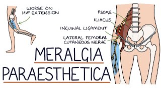 Understanding Meralgia Paraesthetica [upl. by Hnad]