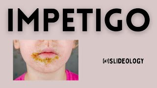 Impetigo Symptoms Causes and Treatment Strategies Explained [upl. by Atterbury]