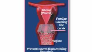 What is the FemCap Cervical Cap [upl. by Herr]