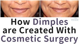 How Cheek Dimples are Created with Cosmetic Surgery [upl. by Gnehs]