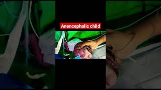 Anencephalic child bscnursing jlnmch [upl. by Maible]