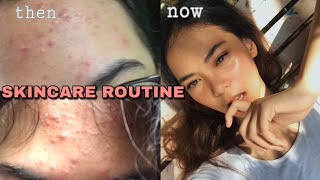 HOW I LOST MY PIMPLES IN 1 MONTH  my acne story  Amelia Salve [upl. by Mikiso]