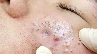 Big Cystic Acne Blackheads Extraction Blackheads amp Milia Whiteheads Removal Pimple Popping  4517 [upl. by Laertnom434]