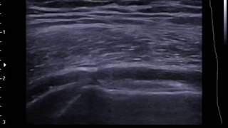 Lateral hip bursa injection on ultrasound  SAX  off plane [upl. by Siddon]