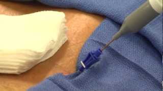 Got Intervertebral Disc Pain Get IntIntradiscal ElectroThermal Annuloplasty [upl. by Acirrej468]