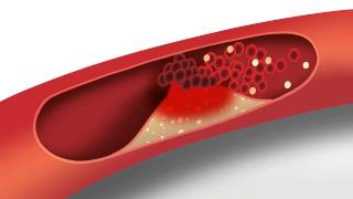 Cholesterol animation  Heart disease risk factors [upl. by Assenal846]