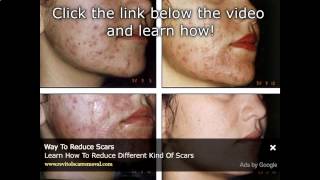 Acne Scar Treatment In The Philippines And AsiaWmv Scar Removal Philippines [upl. by Sandie]