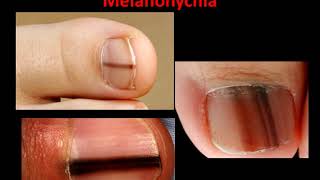 Melanoma Melanonychia  What is it [upl. by Asirem59]