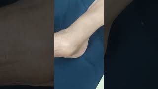 Charcot joint  Neuropathic arthropathy foot clinicalskills [upl. by Rodge]