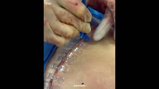 Tummy Tuck incisions closure using Brijjits to reinforce sutures Scar Treatment  Scar Revision [upl. by Wayolle]