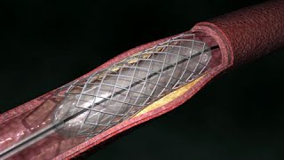 Coronary Artery Angioplasty  Radial Access [upl. by Ecirtram918]