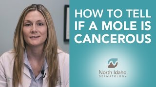 How to Tell if Your Mole is Cancerous  North Idaho Dermatology [upl. by Pepita]