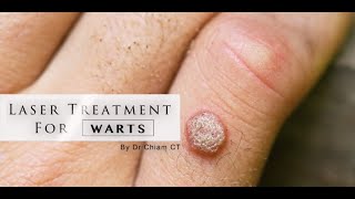 Warts removal with Laser Treatment  Dr Chiam CT [upl. by Sue]