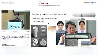 Anatomy amp management of truncus arteriosus [upl. by Ociredef]