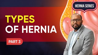 Types of hernias and which is the most severe By Dr Achal  Part 3  Hernia Series  ILC [upl. by Franklin106]