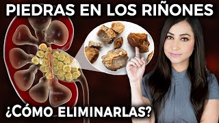 PIEDRAS EN LOS RIÑONES ¿Qué SÍNTOMAS causan y cómo ELIMINARLAS Cálculos renales👩🏻‍⚕️ drapauzuniga [upl. by Nahtnahoj393]