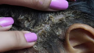 dandruff removal huge flakes scratching on head16 [upl. by Ivetts312]