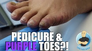 PEDICURE CAUSED PAINFUL PURPLE PINKY TOES [upl. by Esereht]