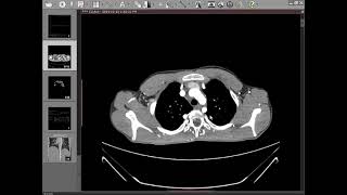 CT Angiography Case06 Coarctation of Aorta [upl. by Sykleb]