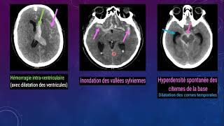 hémorragie méningée sous arachnoidienne [upl. by Kresic]