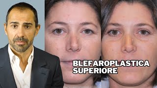 BLEFAROPLASTICA SUPERIORE SPIEGATA in 3 MINUTI Dr F BERNARDINI [upl. by Htur]