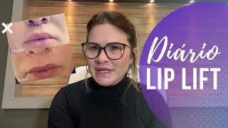 LIP LIFT  ANTES E DEPOIS DO MEU LIP LIFT PREENCHIMENTO LABIAL [upl. by Ecinahc]