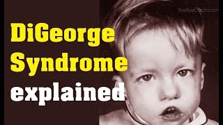 What is DiGeorge Syndrome  Cause and Treatment [upl. by Milman]