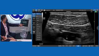 Infraclavicular Brachial Plexus Block [upl. by Adaiha]