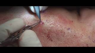 Acne Scar Revision Part 04 More Subcision Technique by Dr Young [upl. by Airamanna]