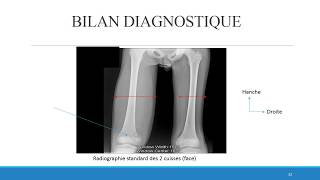 OSTEOMYELITE du STAFF vid [upl. by Gnilrits890]