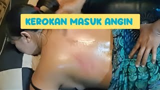 KEROKAN Cara Mengatasi Masuk Angin dan Sirkulasi Darah [upl. by Thedrick]