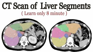 CT scan of Liver segments anatomy [upl. by Cirre]