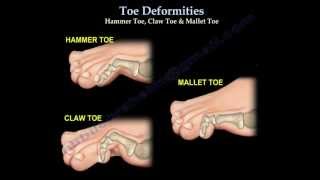 Toe Deformities Hammer Claw amp Mallet Toes  Everything You Need To Know  Dr Nabil Ebraheim [upl. by Roseanne]