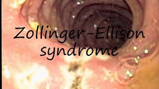 How to Pronounce ZollingerEllison syndrome [upl. by Aniraz260]