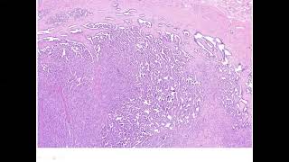 Papillary Renal Cell Carcinoma [upl. by Carrie]