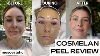 COSMELAN DEPIGMENTATION PEEL  chemical peel for pigmentation  dark spots [upl. by Gloriana130]