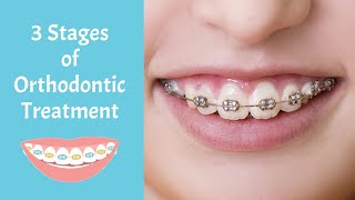 The 3 Stages of Orthodontic Treatment [upl. by Matthiew657]