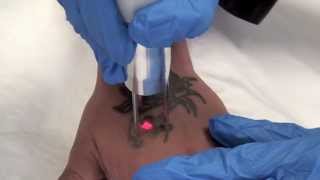 QSwitched NdYAG Tattoo Removal Laser  The Astanza Duality [upl. by Andie30]