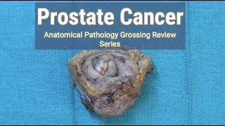 Prostate Cancer  Anatomical Pathology Grossing Review Series [upl. by Now]